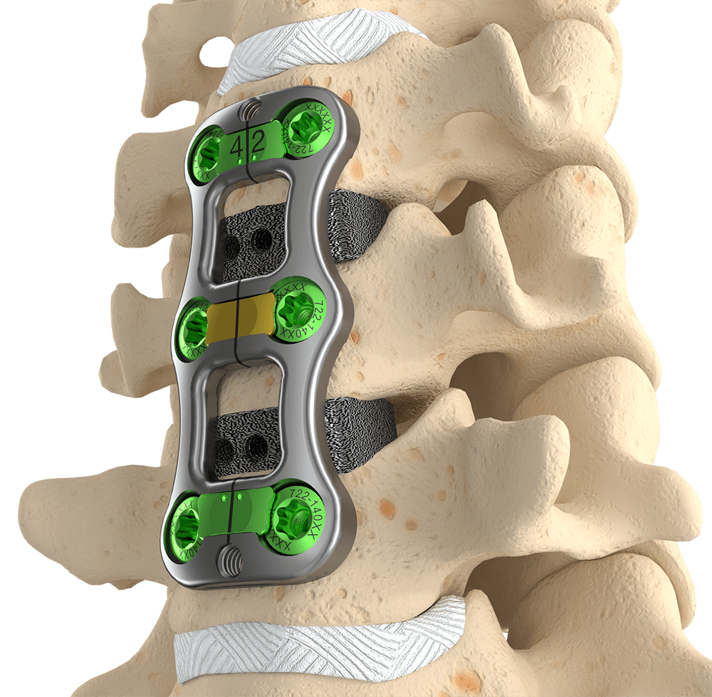 ACDF - Trestle Luxe II - ATEC Spine