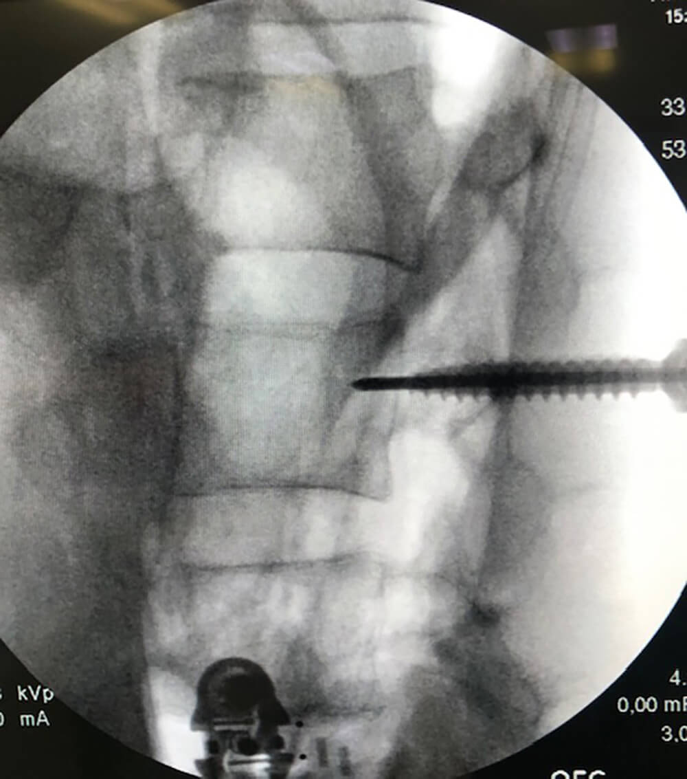 PF - SingleStep - Japan - ATEC Spine