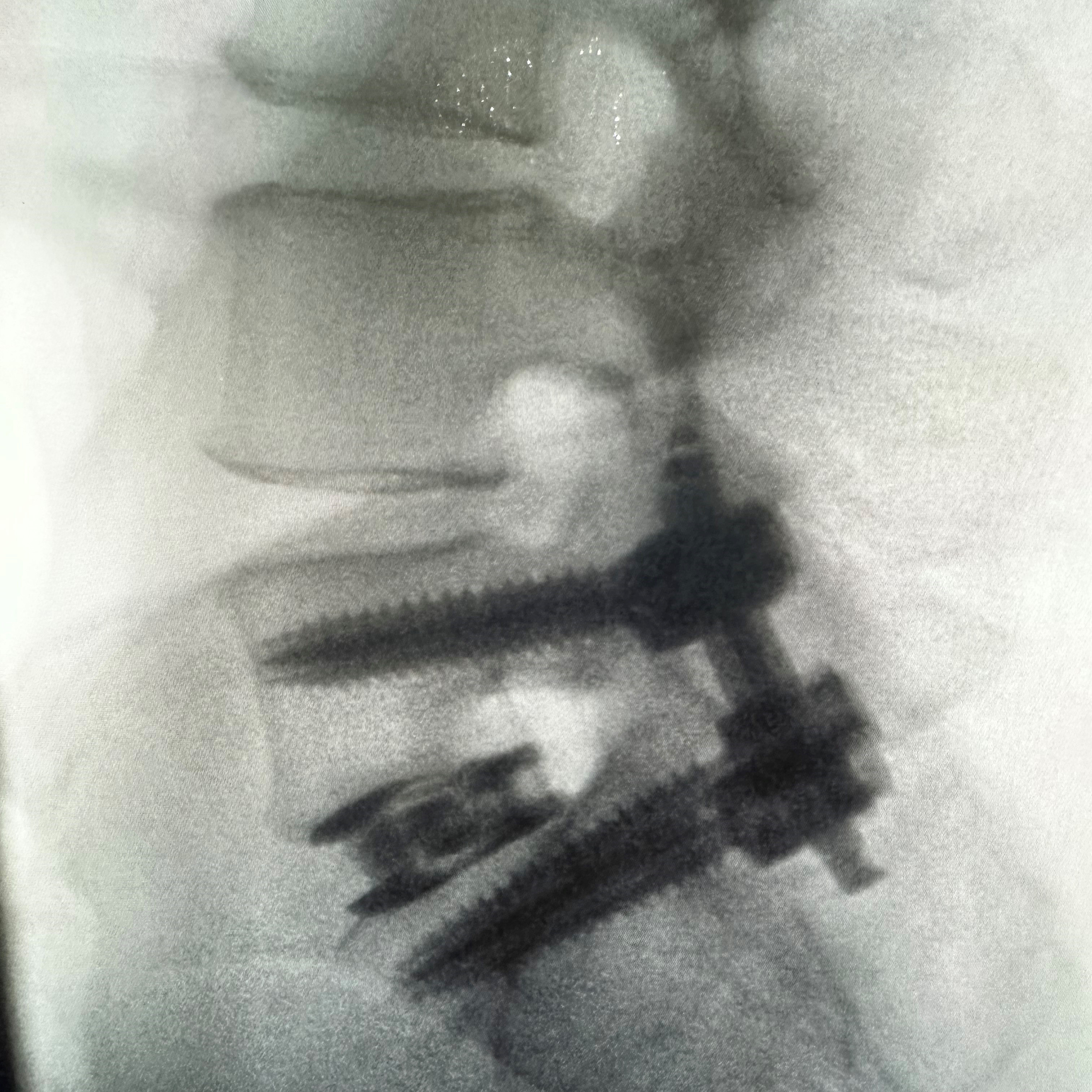 plif lateral x-ray with Calibrate PSX