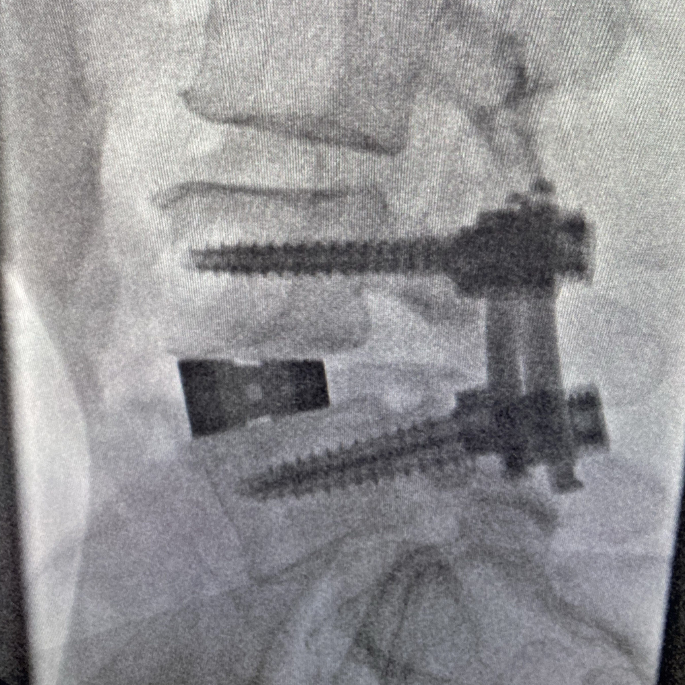 atec spine x-ray of the ptp procedure