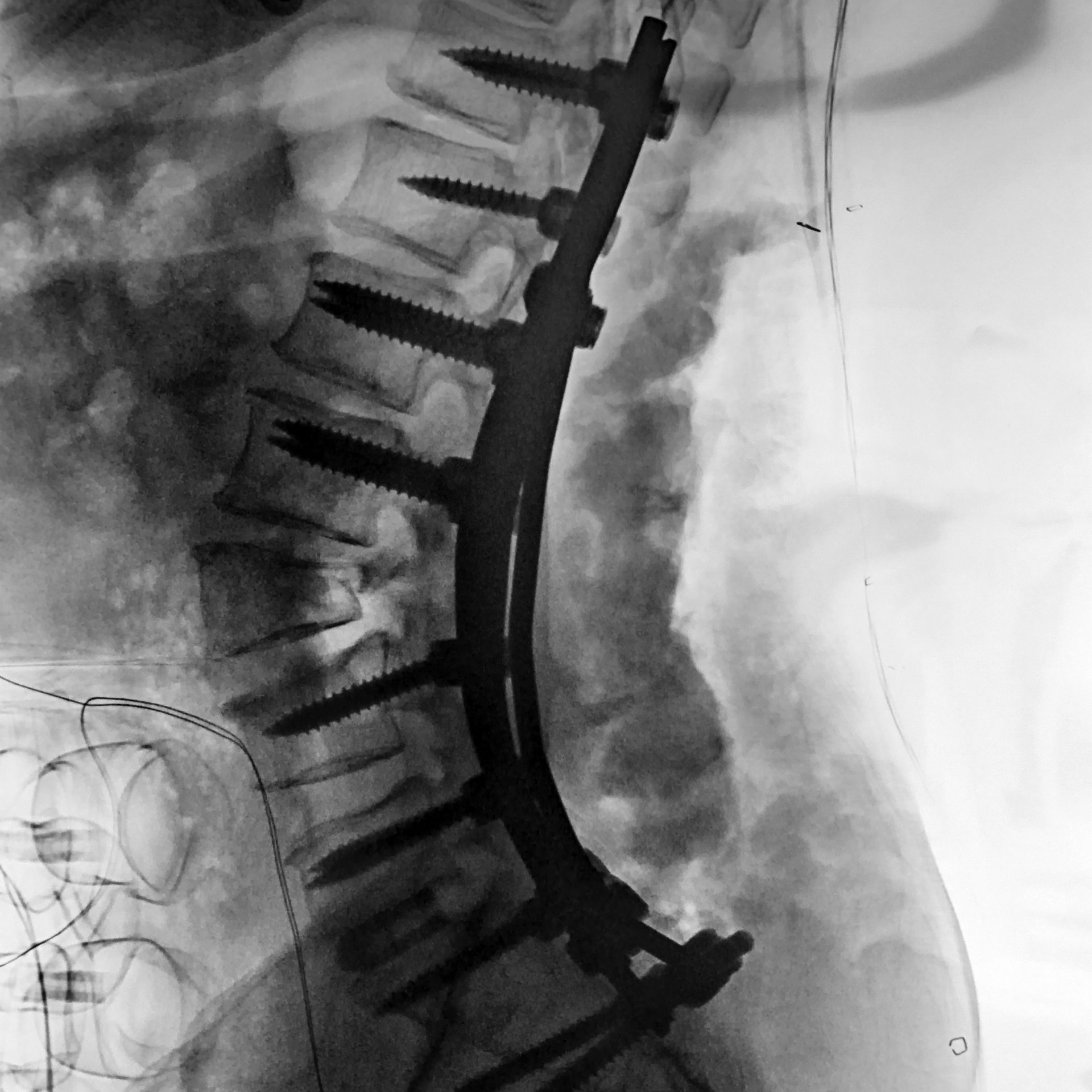 x-ray of posterior fixation