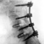 x-ray of plif procedure of the spine